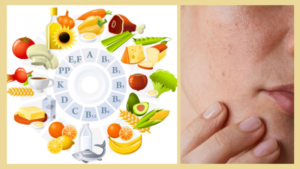 Da khô thiếu chất gì? Cách khắc phục hiệu quả để làn da mềm mịn