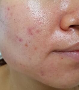 Nguyên nhân lỗ chân lông to khiến bạn không lo lắng 