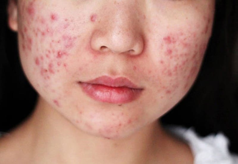 Dấu Hiệu Của Mụn Trứng Cá