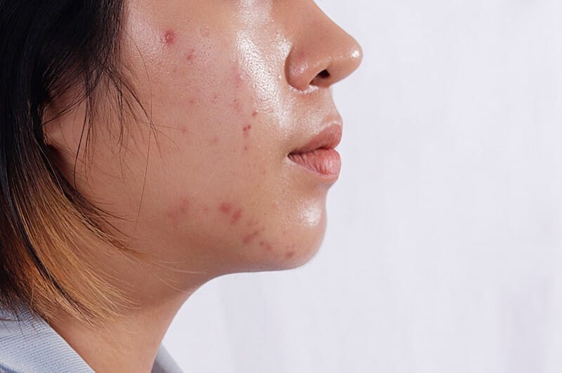 Hiểu rõ đặc điểm của da dầu vào mùa đông