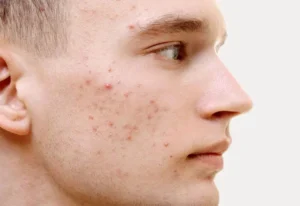 Mụn Trứng Cá Là Gì? Nguyên Nhân, Dấu Hiệu và Cách Điều Trị Mụn Trứng Cá