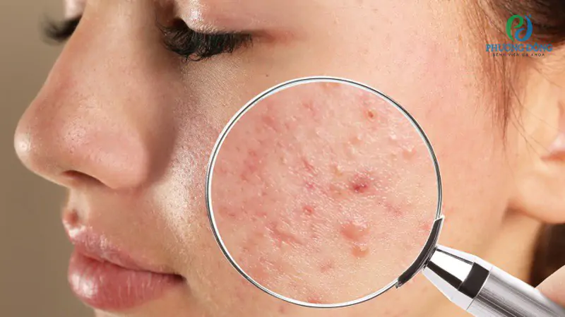 Nguyên Nhân Gây Mụn Trứng Cá