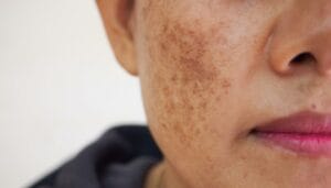 Cách chăm sóc da mặt bị nám - Quy trình chăm sóc da mặt