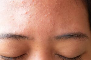 Da mặt bị sần: Nguyên nhân, cách khắc phục và những điều cần lưu ý