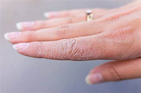 Nguyên nhân phổ biến khiến da khô