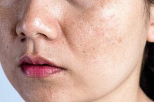 Nám da là gì? Dấu hiệu và cách điều trị nám da bạn nên biết