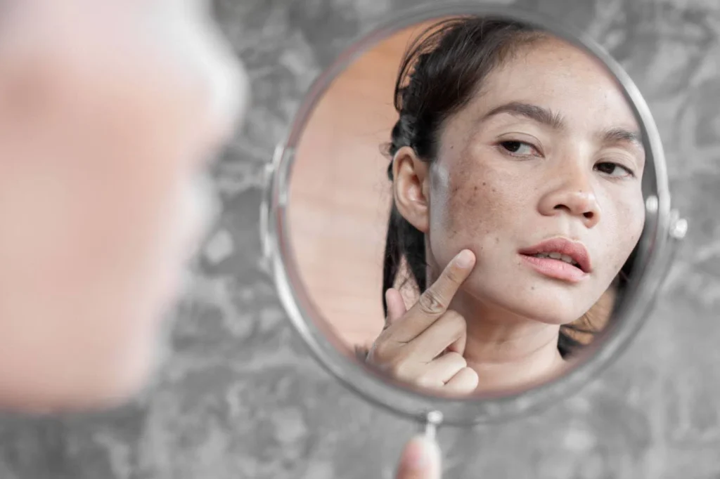 Phòng ngừa nám da như thế nào?