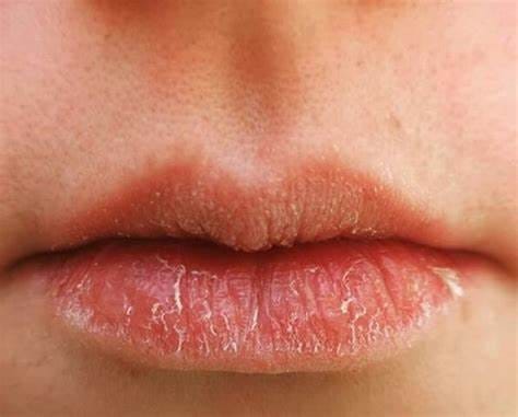 Triệu chứng của khô môi